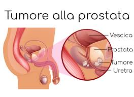 L’urologo: tumori alla prostata, consigli utili e la novità nella diagnosi